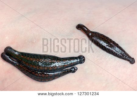 Medical leeches on human skin. Alternative therapy.