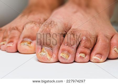 A Toenail Fungus At The Peak Of The Infection.