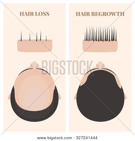 Man Before And After Hair Regrowth Transplantation