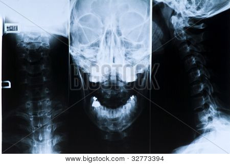 Radiografie hlavy a krku