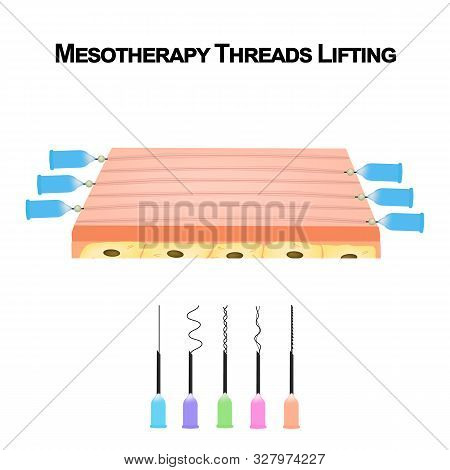 Mesotherapy Threads Lifting. Different Types Of Threads For Facelift. The Structure Of The Skin. Wri