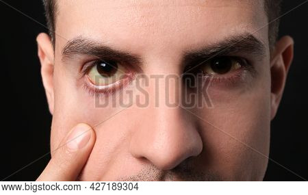 Man Checking His Health Condition On Black Background, Closeup. Yellow Eyes As Symptom Of Problems W