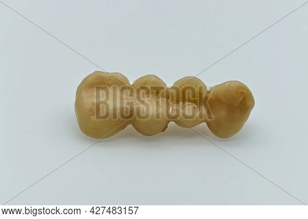 Temporary Resin Teeth. Provisional Dental Bridge. Dental Implant Concept