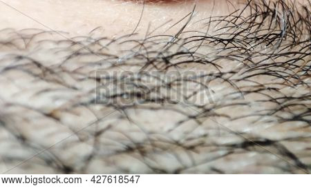 Closeup Of Caucasian Skin With Ingrown Hair And Man Short Beard. Close Up Of Caucasian Skin With Man