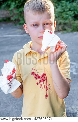 Nasal Blood, A Cute Boy Who Suffers From Nosebleeds And Uses Paper To Stop Bleeding. High Quality Ph