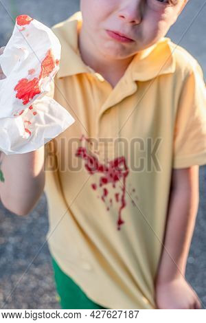 Nasal Blood, A Cute Boy Who Suffers From Nosebleeds And Uses Paper To Stop Bleeding. Focus On The Na