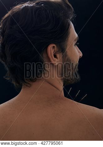 Acupuncture, Reflexology. Close-up View From Male Patient Back With Acupuncture Needles In His Shoul