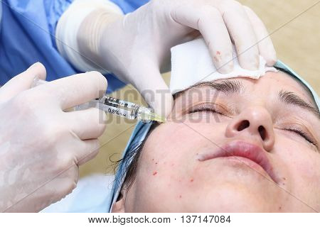 Bio-revitalization with hyaluronic acid treatment of mimic wrinkles