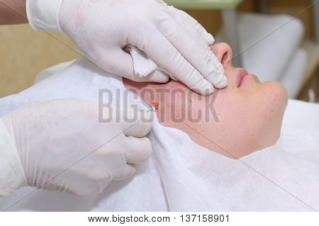 Procedure of face lifting surgery in clinic