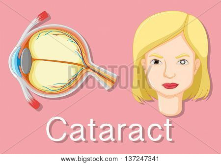 Diagram showing unhealthy eye with cataract illustration