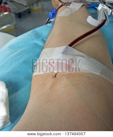 Blood Transfusion At The Hospital