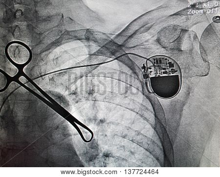 VVIR pacemaker in x-ray image in cardiac catheterization laboratory