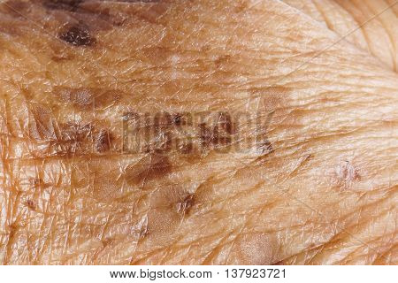 Freckle on skin closeup / sign of aging