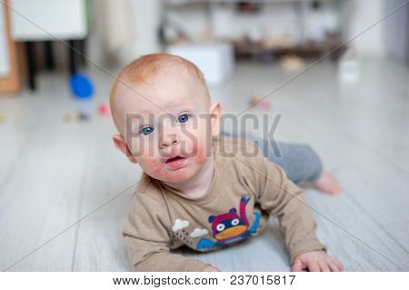 Traces Of Diathesis, Allergies On Baby Cheeks