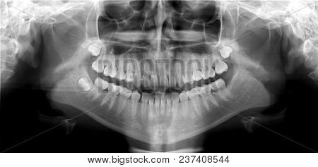 Original Black White X-ray Teeth Scan Mandible. Panoramic Negative Image Facial Of Young Adult Male.