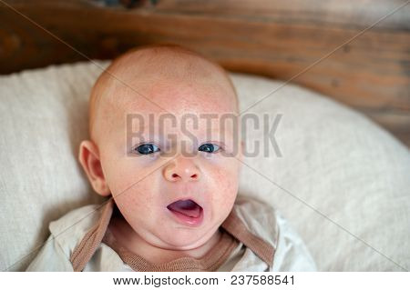 Allergies, Atopic Dermatitis On The Face Of A Baby