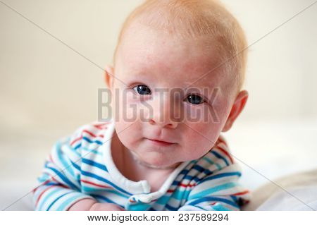 Allergies, Atopic Dermatitis On The Face Of A Baby