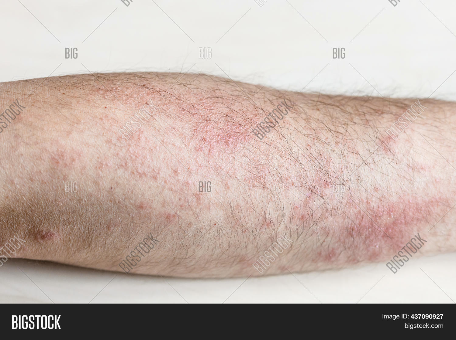 Sample Allergic Image & Photo (Free Trial) Bigstock