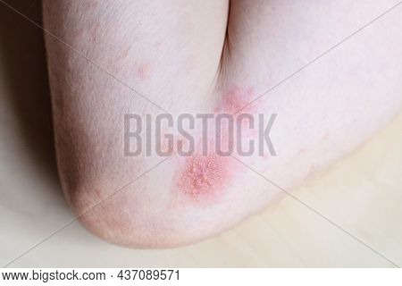 Sample Of Allergic Contact Dermatitis - Blisters On Iinner Bend Of The Elbow Close Up