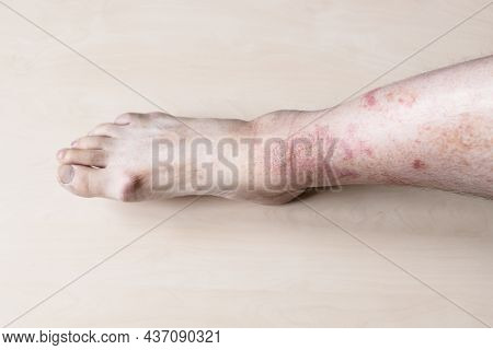 Sample Of Allergic Contact Dermatitis - Male Shin With Itchy Red Rash On Skin