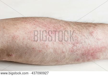 Sample Of Allergic Contact Dermatitis - Rash On Outside Forearm Close Up