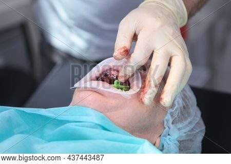 Surgery To Install Multiple Implants In Dental Clinic. Operation Under General Anesthesia. Old Man.