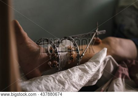 Patient With Ilizarov Apparatus Fixation After Orthopedic Surgery. Limb-sparing Technique Treat Comp