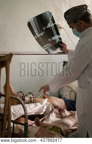 Male Doctor Checking On Patient With Ilizarov Apparatus Fixation After Orthopedic Surgery Holds X-ra