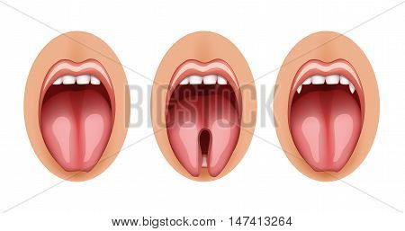 illustration of a split tongue and fangs graft