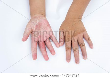 Dry hands peel Contact dermatitis fungal infections Skin infections from exposure