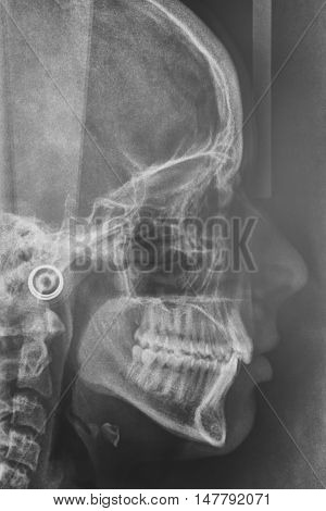 Maxilofacial X-Ray for a dentist treatment. Orthodontics diagnosis. Medical