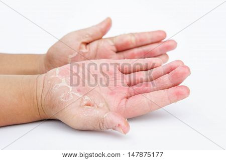 Dry hands peel Contact dermatitis fungal infections Skin infections from exposure