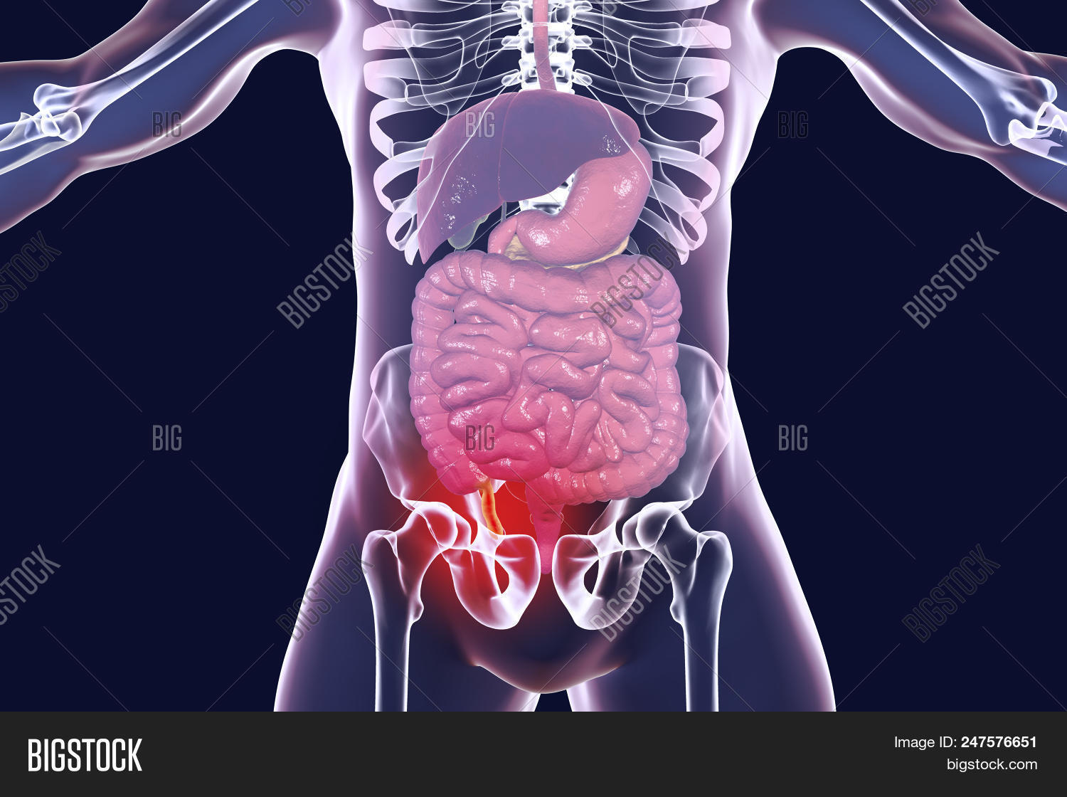 Acute Appendicitis, 3d Image & Photo (Free Trial) Bigstock
