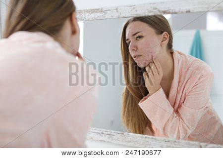 Young Woman With Acne Problem Near Mirror In Bathroom