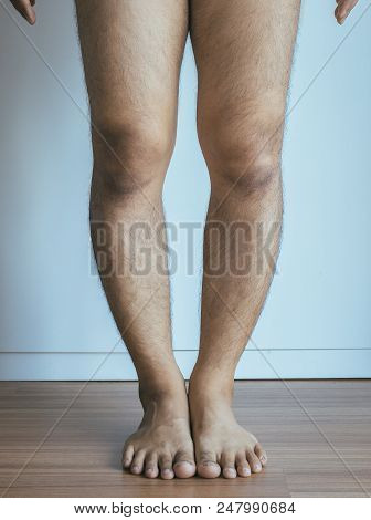 Asian Man Leg Bandy-legged Shape Of The Legs