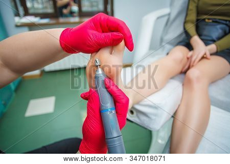 Podiatrist Treating Toenail Fungus. Podology Treatment. Close-up.