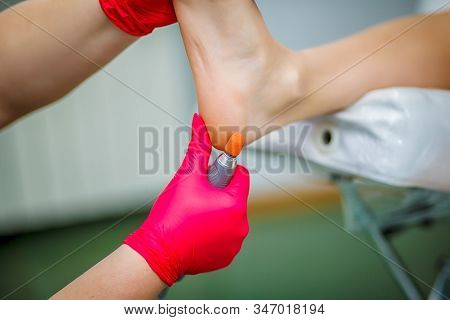Podiatrist Treating Toenail Fungus. Podology Treatment. Close-up.