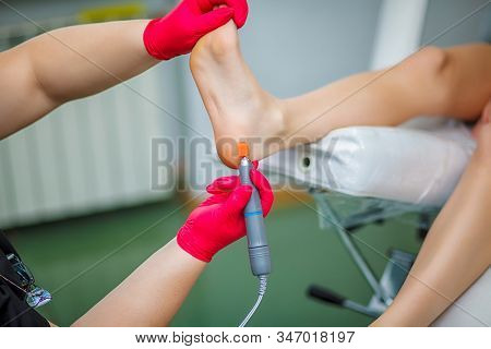 Podiatrist Treating Toenail Fungus. Podology Treatment. Close-up.