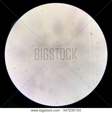 Moderate Dysmorphic Red Blood Cells In Urine Sediment.
