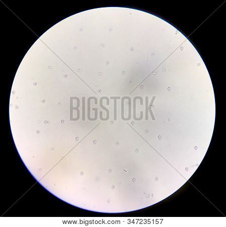 Moderate Dysmorphic Red Blood Cells In Urine Sediment.