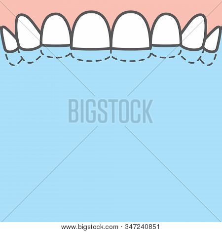 Blank Banner Upper Attrition (bruxism) Teeth Illustration Vector On Blue Background. Dental Concept.