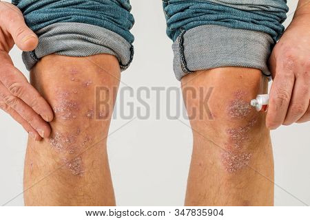 Application Of Therapeutic Ointment For Allergic Rashes On The Leg. Treatment Of Psoriasis, Cosmetic