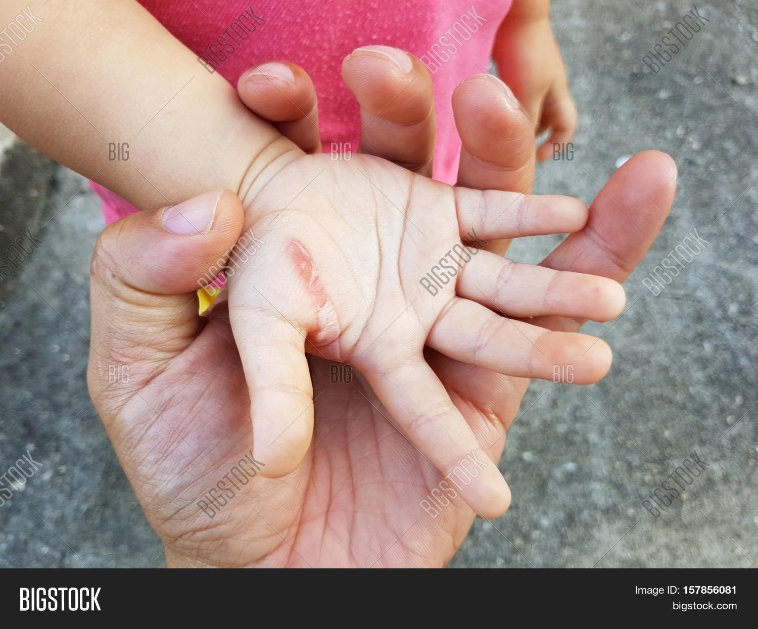 Wound Hand Child Iron Image & Photo (Free Trial) Bigstock