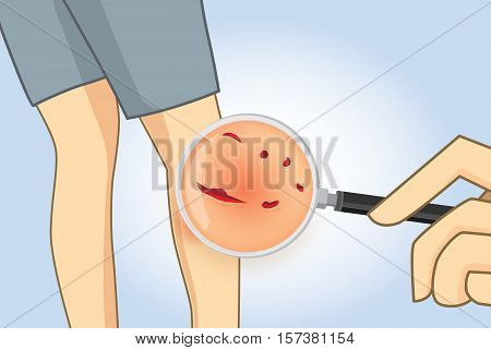 Zoom in leg with magnifier for looking dog bite wounds. Bloody from calf leg.