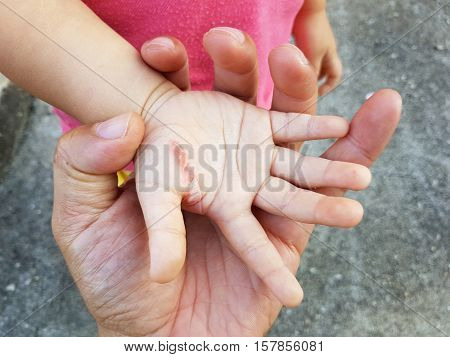 wound in the hand of a child from an iron burn in father's hand