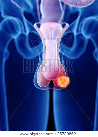 3d rendered medically accurate illustration of testicle cancer