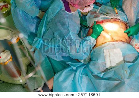 Cosmetic Liposuction Surgery In Actual Operating Room, Group Of Surgeons Working With Cannula