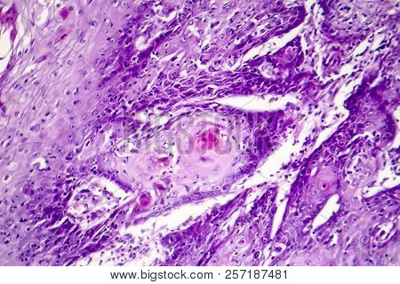 Cutaneous Squamous Cell Carcinoma, Light Micrograph, Photo Under Microscope Showing Typical Keratino