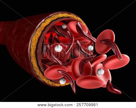 The Difference Of Normal Red Blood Cell And Sickle Cell, 3d Illustration About Medical