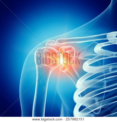 3d rendered medically accurate illustration of a painful shoulder joint